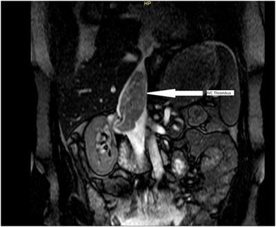 Technical Intraoperative Maneuvers for the Management of Inferior Vena Cava Thrombus in Renal Cell Carcinoma